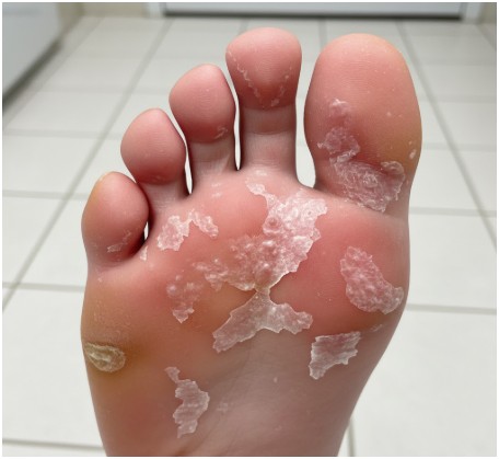 Athlete's Foot- Foot and Nail Care