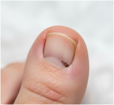 Ingrown Toenails- Foot and Nail Care