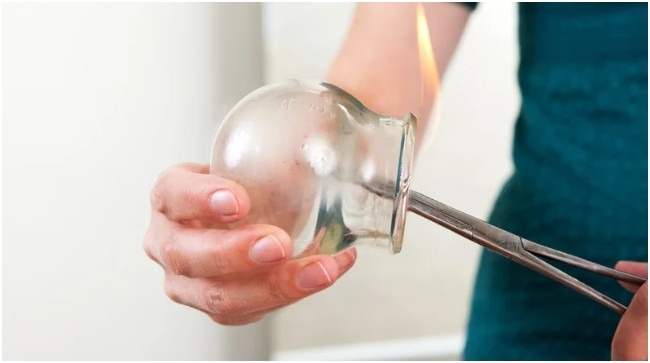 The Renaissance of Cupping Therapy